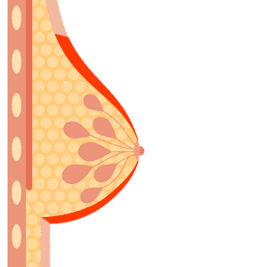 Illustration: Anatomie der Brust bei inflammatorischem Brustkrebs